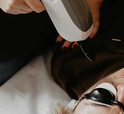 Carbon Peeling kezelés Kapuváron – mélytisztító arctisztítás és bőrfiatalítás