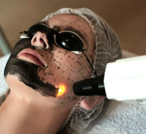 Carbon Peeling lézeres arckezelés Kapuváron – kollagéntermelés fokozása és bőrmegújítás