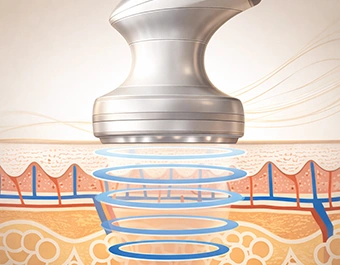 Kavitációs zsírbontó kezelés ultrahangos technológiával Kapuváron