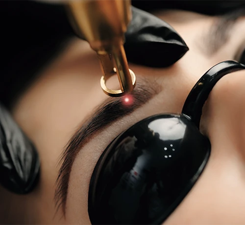 Lézeres tetoválás eltávolítás Kapuvár