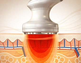 Rádiófrekvenciás zsírbontó kezelés a bőr feszesítésére és alakformálásra Kapuváron