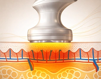 Soft lézeres alakformáló kezelés a zsírbontás támogatására Kapuváron