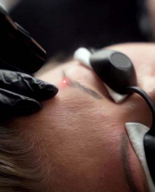 Lézeres tetoválás eltávolítás, lézer, pigment, tetoválás,Kapuvár