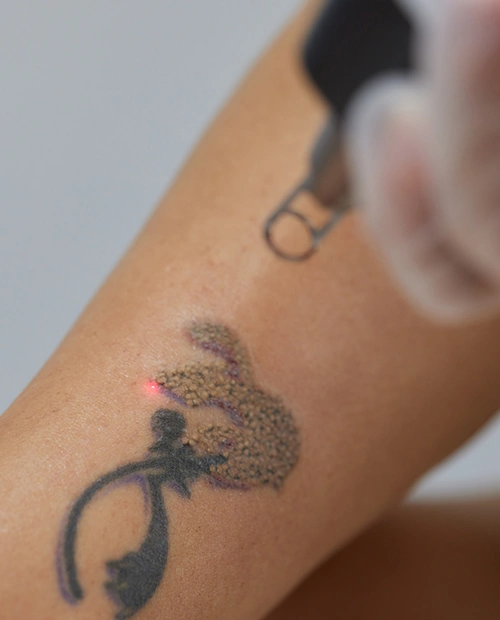 Lézeres tetoválás eltávolítás, tetoválás, állapotfelmérés, személyes konzultáció, Kapuvár