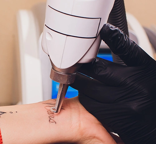 Lézeres tetoválás eltávolítás, tetoválás, régi tetoválás, kopott tetoválás, Kapuvár