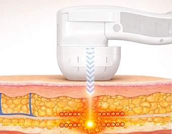 UTIMS Hifu, bőrfiatalítás, SMAS réteg, arclifting, Kapuvár