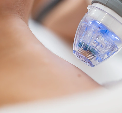 Vace mikrotűs rádiófrekvenciás kezelés, bőrtípus, személyre szabott kezelés, orvosi CE minősítés, Kapuvár