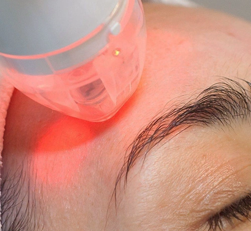 Vace mikrotűs rádiófrekvenciás kezelés, bőrfeszesítés, ránctalanítás, heg halványítás, Kapuvár